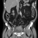 Diverticulitis, severe, colovesical fistula, fistula, vesicoureteral reflux: CT - Computed tomography